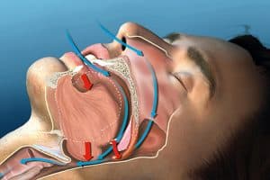 Anti-snoring-device-report